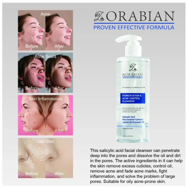 Pigmentation Acne Control Cleanser - Image 5